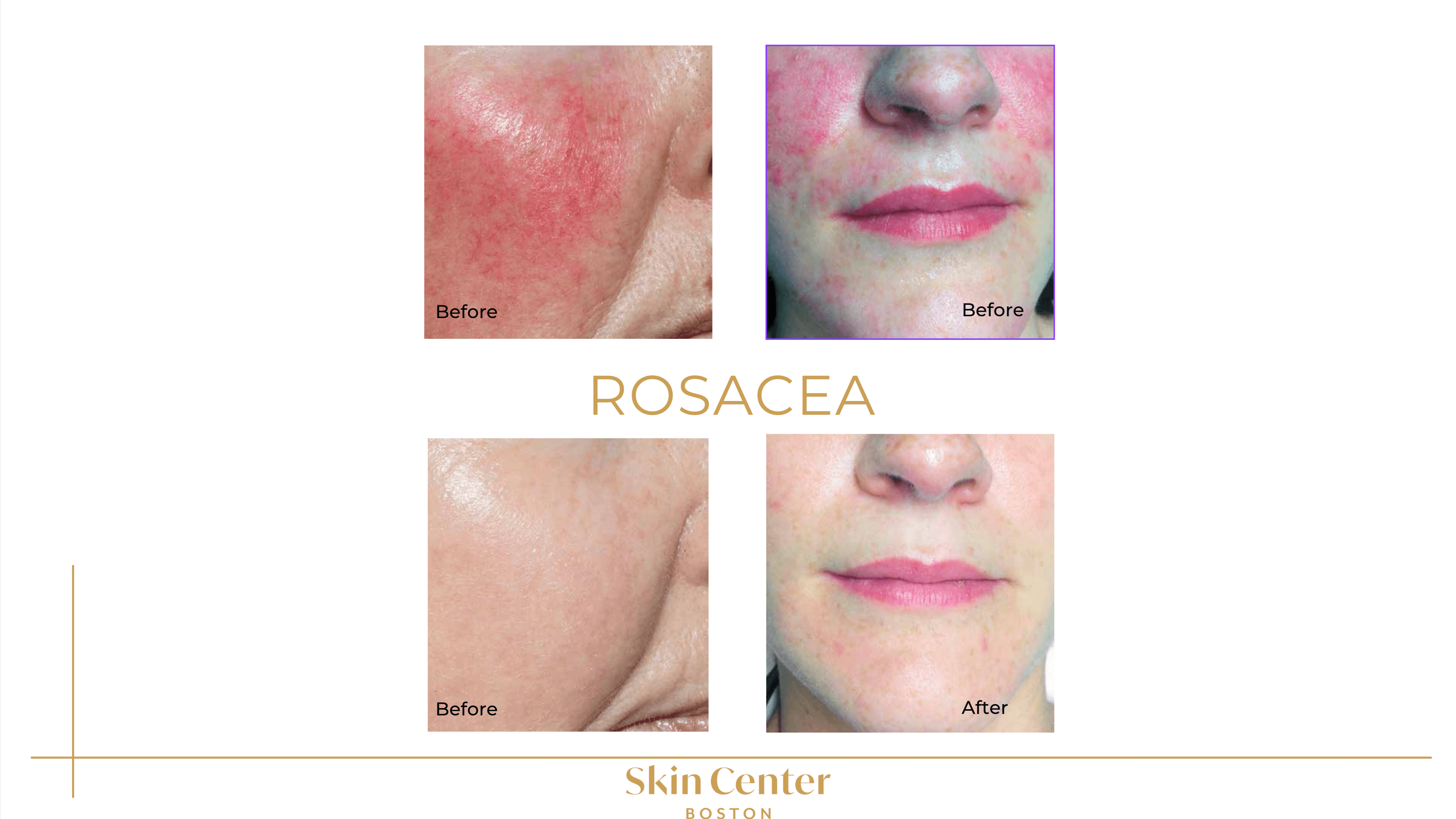 IPL Rosacea Before & After